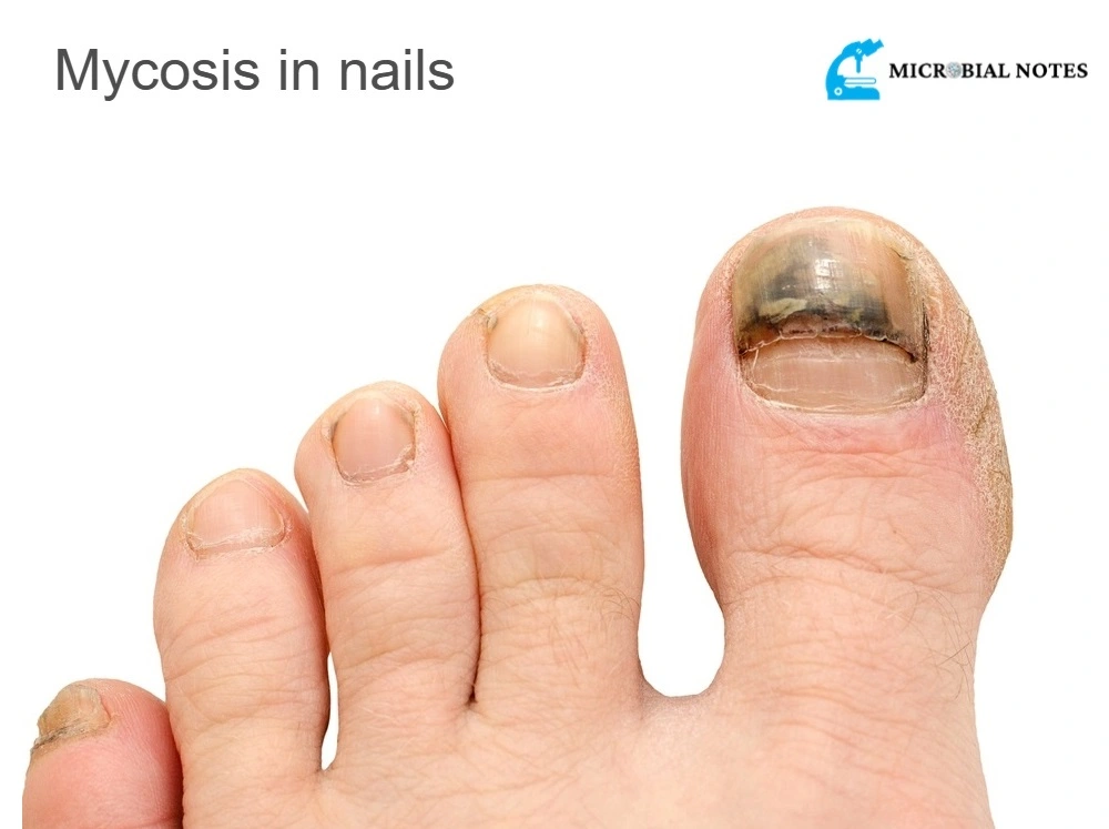 mycosis in nails