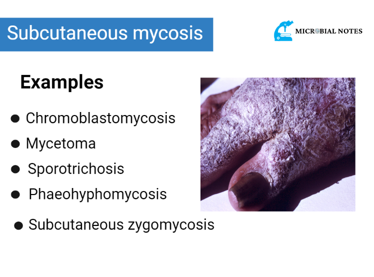 subcutaneous mycosis