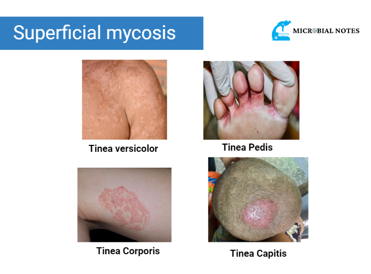superficial mycosis and its types