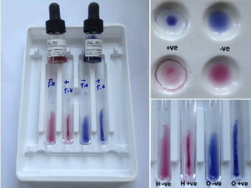 positive results of widal test